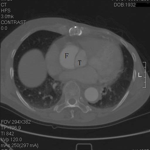 主动脉夹层早期征兆35岁,主动脉夹层早期征兆心率