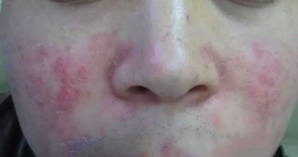 酒渣鼻严重怎么彻底治疗,酒渣鼻难道真的看不好吗