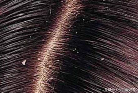 最近脱发越来越严重怎么控制脱发,脱发怎么办最有效最快的方法