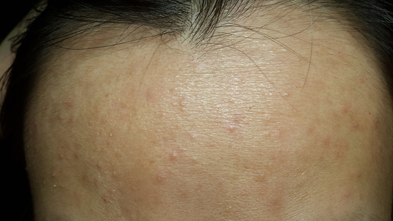 脸部两侧长痘是什么原因怎么办,脸部不同部位长痘是什么原因