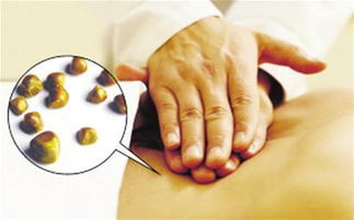 100多颗胆结石经肠道微创取出无需打孔不留疤痕