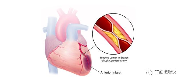 心肌梗死干细胞治疗,自身骨髓干细胞移植治疗心肌梗死