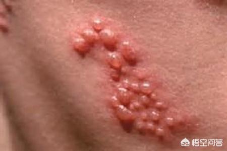 啥是上火,吃点辣椒就上火是什么原因