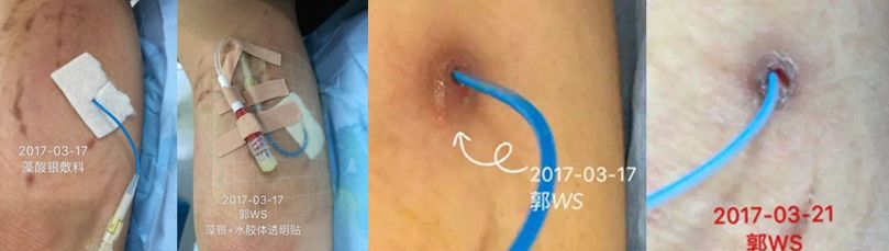 穿刺导致血液细菌感染怎么办,输液港穿刺点感染的原因