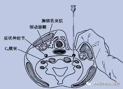 改善失眠20分钟还你高质量睡眠,改善睡眠的神奇效果