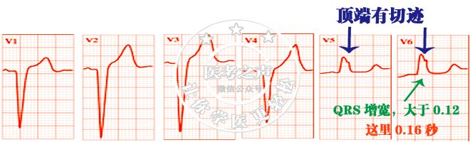 心电图秒懂,心电图零基础都秒懂
