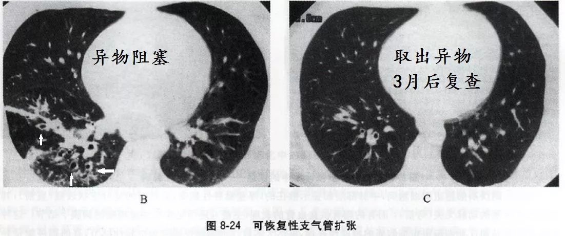 支气管扩张能治好吗要怎么治,支气管扩张能治好吗如何治疗