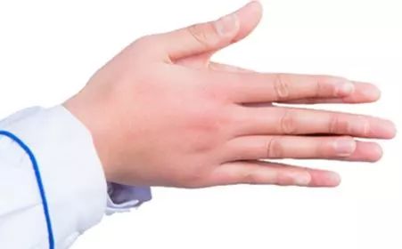 冻疮怎么消除才能彻底好,冻疮怎么预防除根