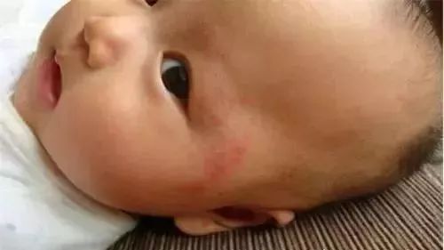 一块钱的红霉素软膏有什么功效,红霉素软膏为啥这么便宜