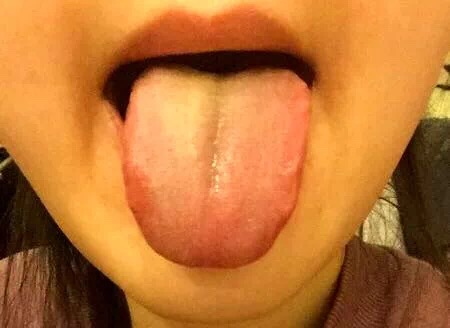 根据舌苔辨别身体情况,舌苔白厚什么原因吃什么中成药