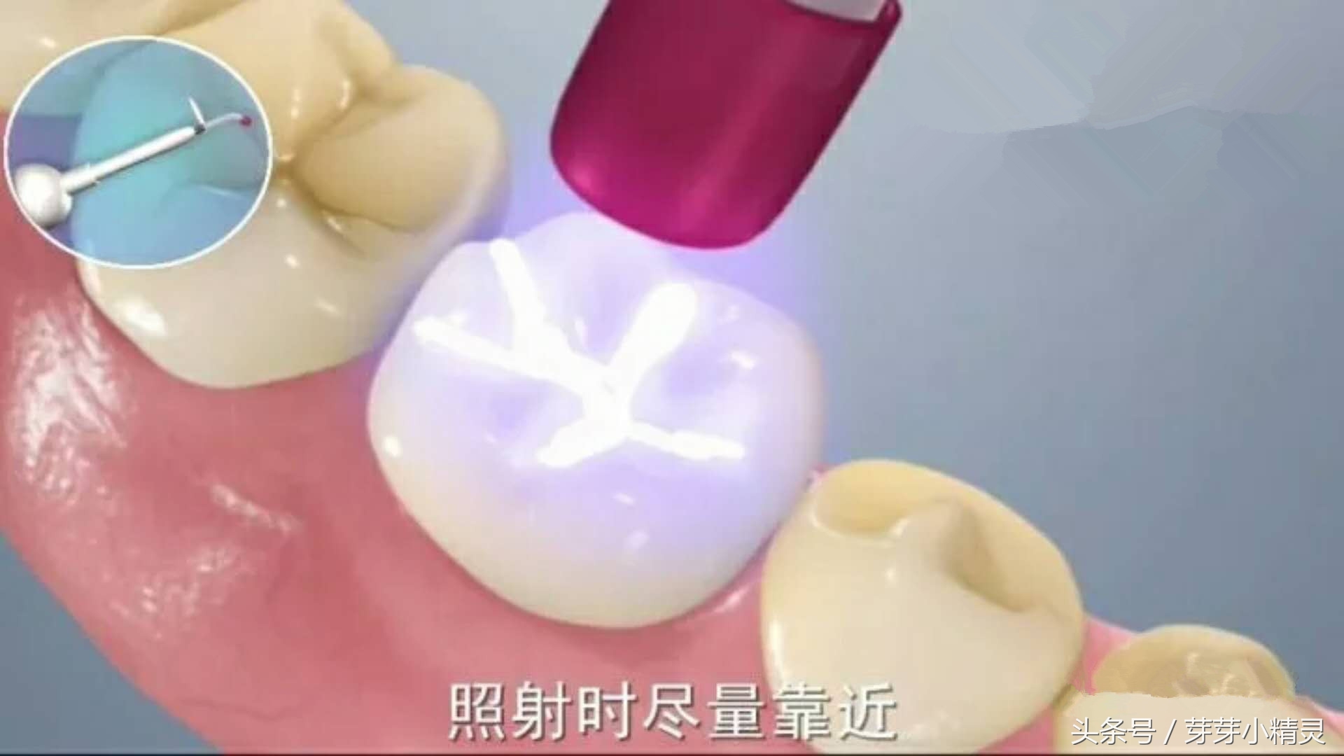 窝沟封闭注意事项,虫牙可以做窝沟封闭吗