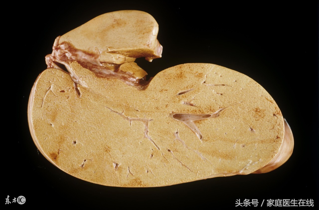 有这4个症状说明肝脏有问题,肝脏实质性占位病变有什么症状