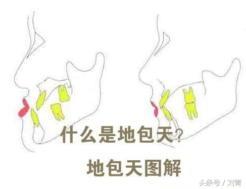 牙齿地包天怎么矫正最佳时间,地包天7岁换牙期间可以矫正吗