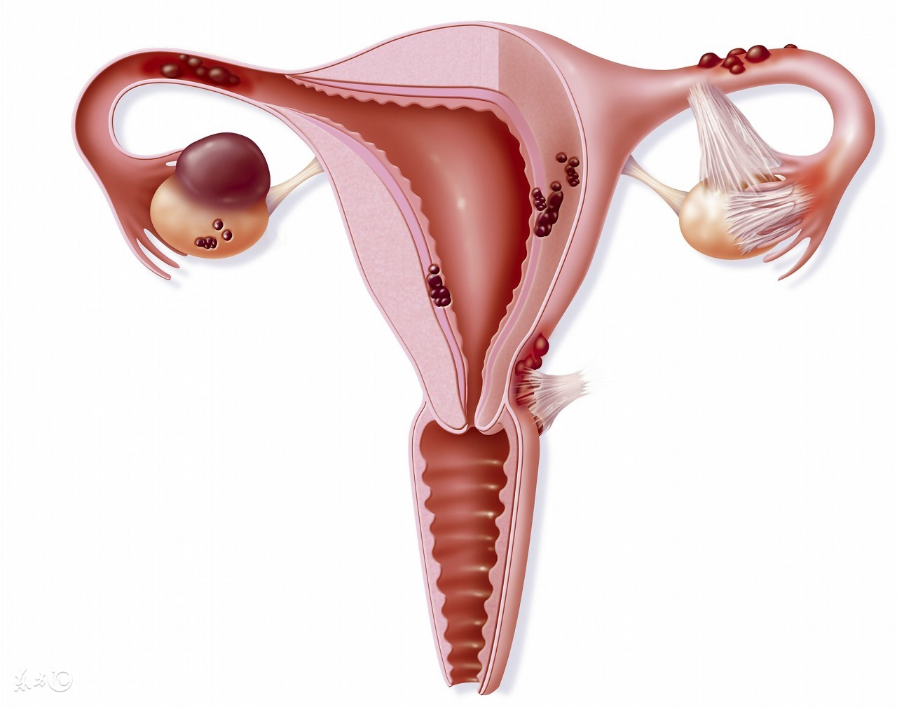 子宫肌瘤会发生囊性变会恶化吗,子宫肌瘤会导致上皮细胞坏死吗