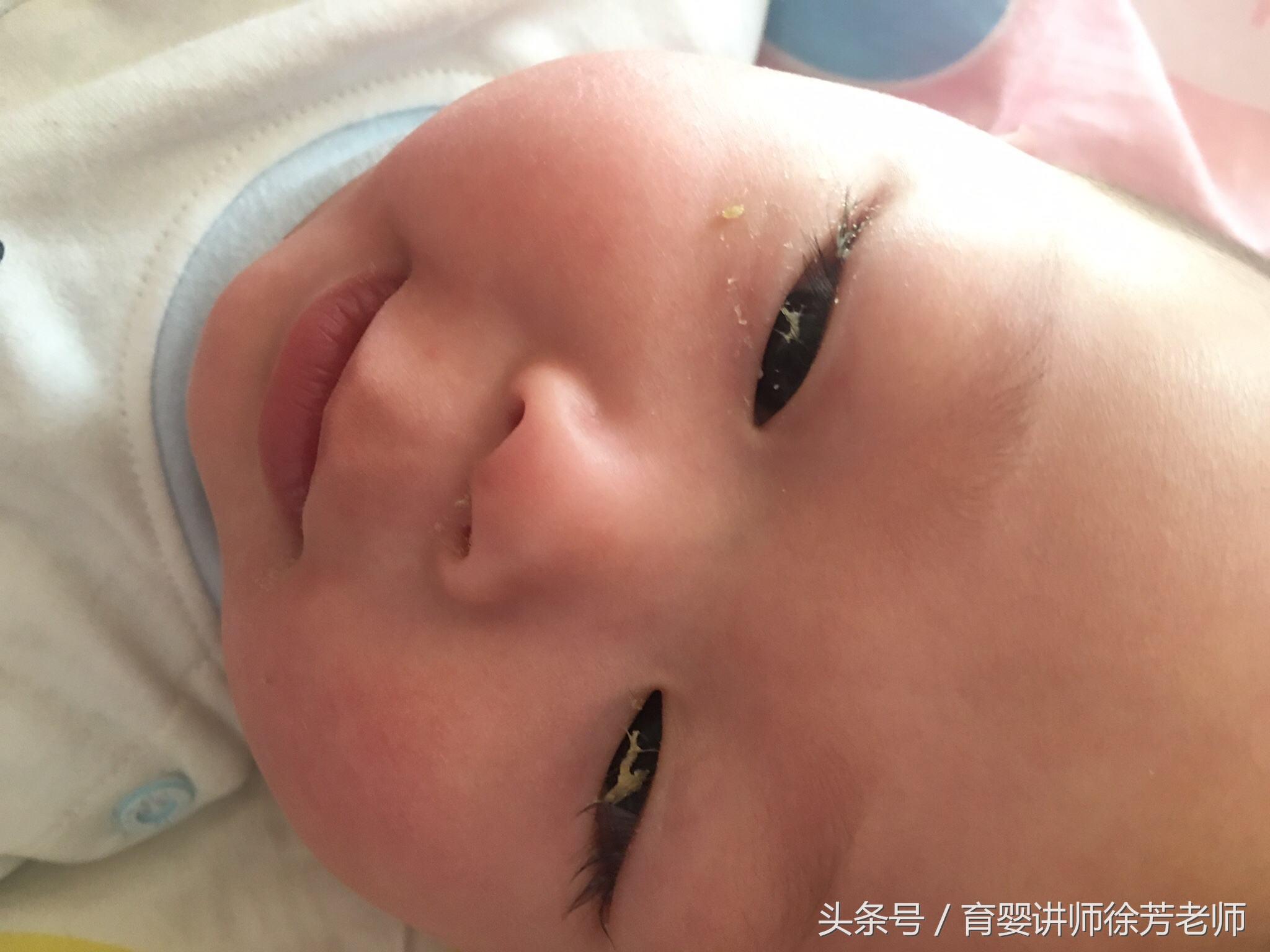 宝宝有眼屎吃什么调理,眼睛有眼屎是什么症状