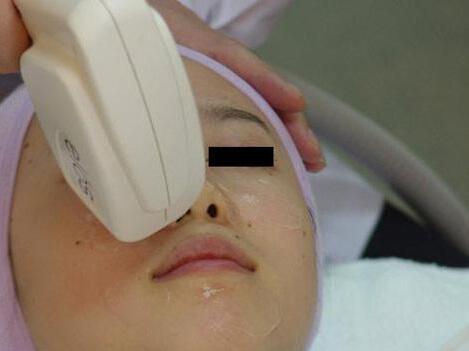 光子嫩肤痘印去不掉啊,做完光子嫩肤痘印加深