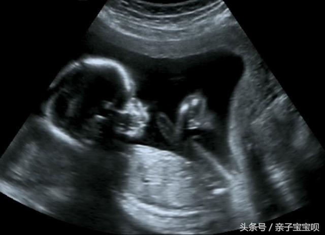 怀孕八个月忽然早产,胎儿“伸手”求救被拒,医生怒斥婆婆太狠心