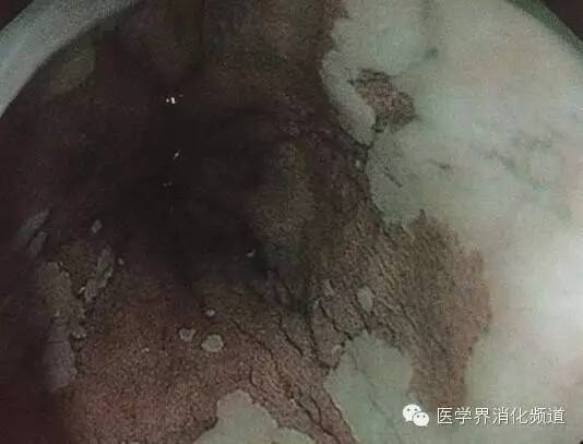 barrett食管的症状是什么,barrett食管是什么意思