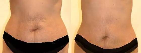 教你如何用腹带,怎么正确使用腹带收腹