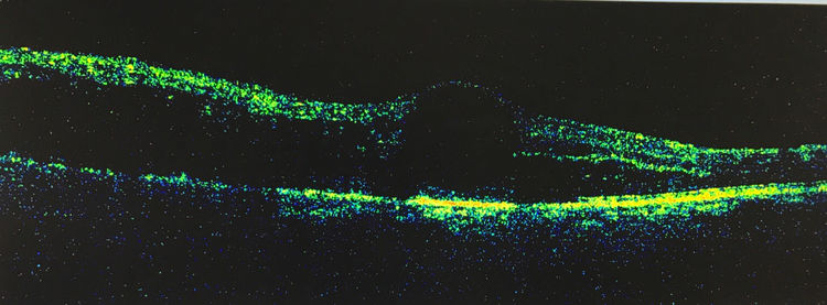 眼底黄斑凹陷怎么办,眼底黄斑怎么去除
