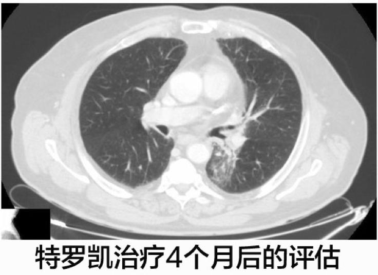 案例：化疗失败的EGFR阴性肺腺癌使用特罗凯病灶完全消失