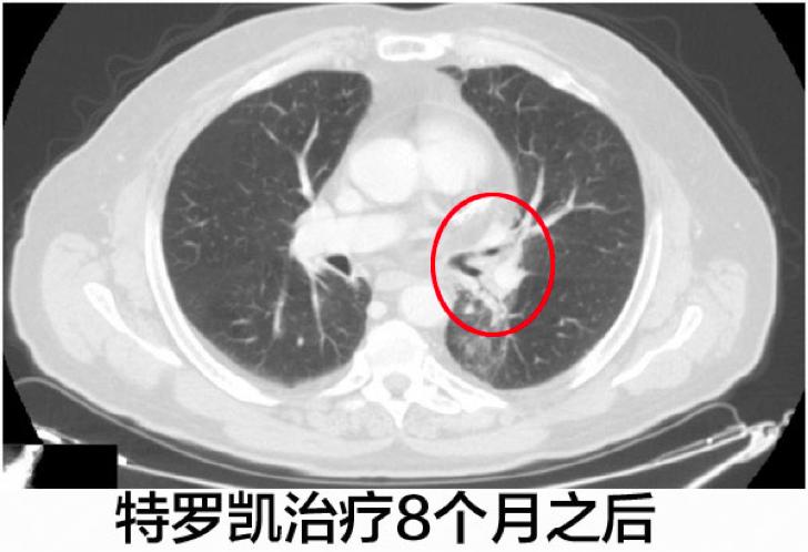案例：化疗失败的EGFR阴性肺腺癌使用特罗凯病灶完全消失