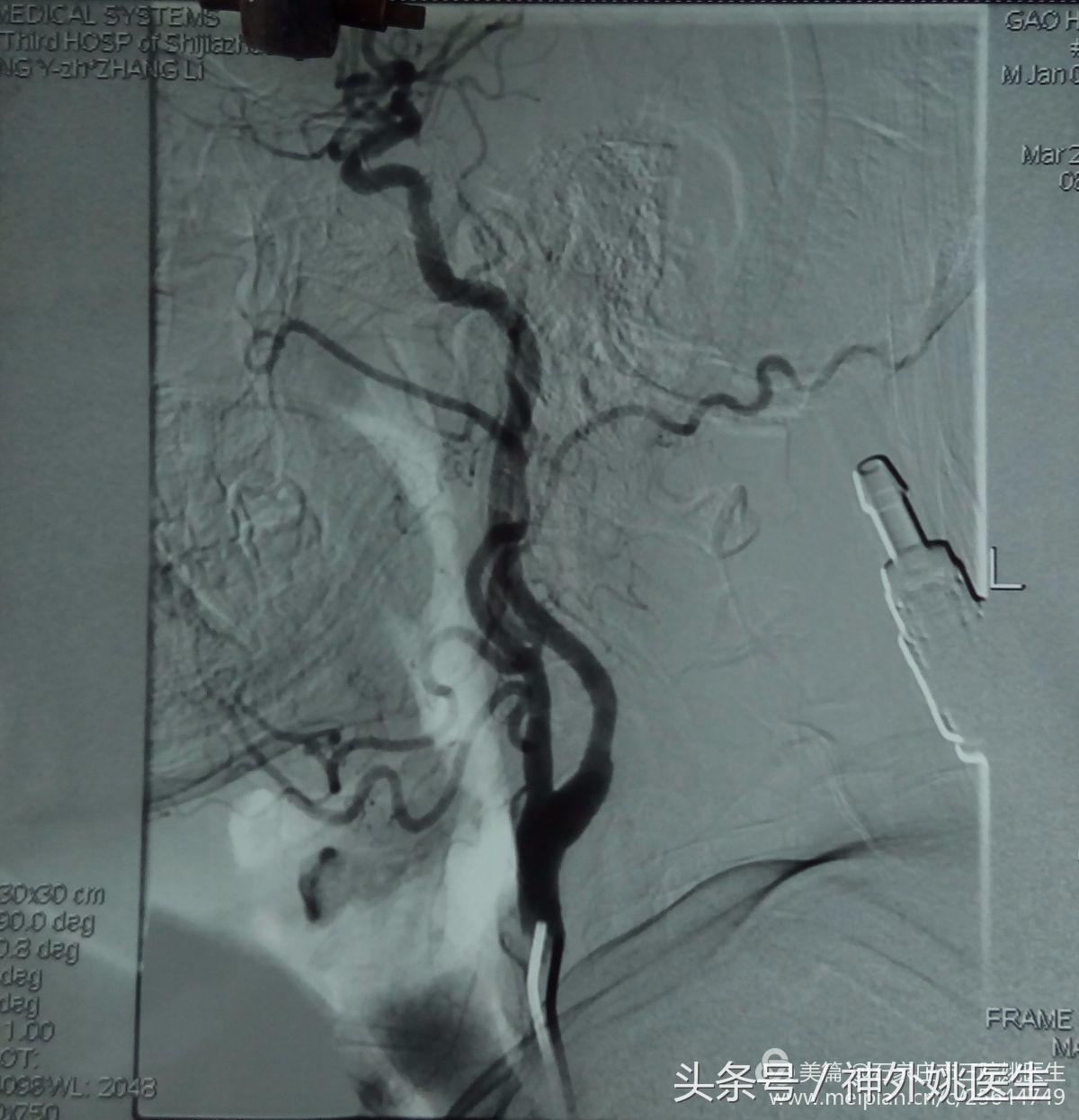 颈内动脉狭窄可以做内膜剥脱术吗,颈内动脉内膜剥脱手术指征