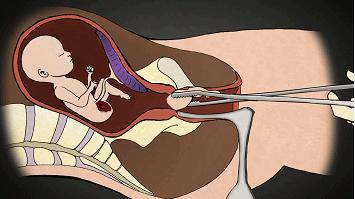 堕胎时人类是怎样一步步杀死自己孩子的?妈妈会看哭!