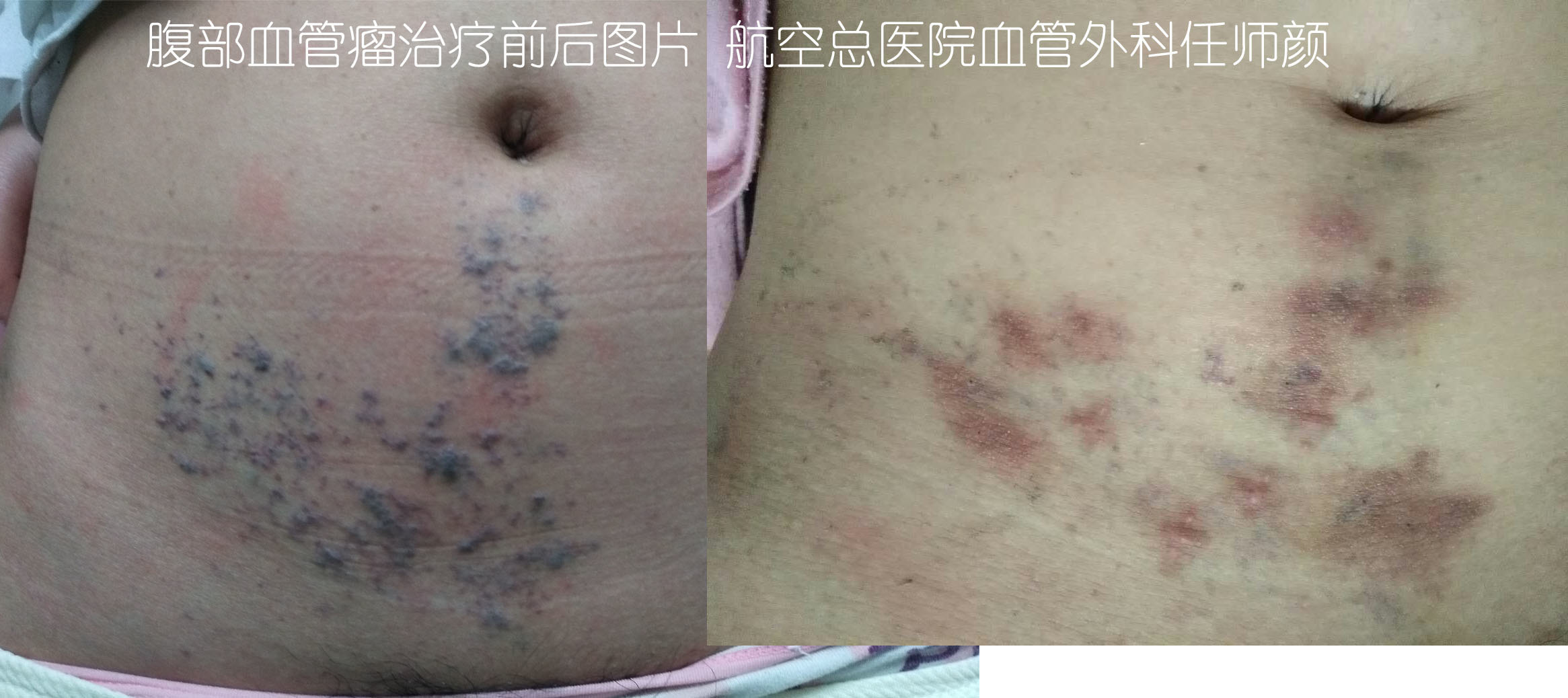 中药治肝血管瘤,血管瘤好治吗