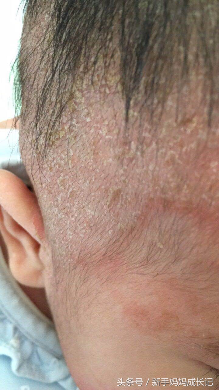 婴儿湿疹的分类及症状,湿疹多久变成慢性湿疹症状