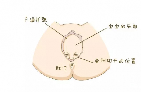 女人怕顺产侧切,为什么有的女的觉得顺产很丢人