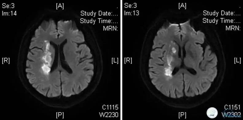 颅内动脉狭窄介入治疗研究,颅内血管cta副作用