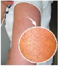 如何摆脱鸡皮肤让肌肤顺滑娇嫩,夏天鸡皮肤怎么去除最有效