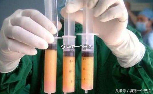 玻尿酸和自体脂肪填充哪个更安全,玻尿酸填充好还是自体脂肪好一些