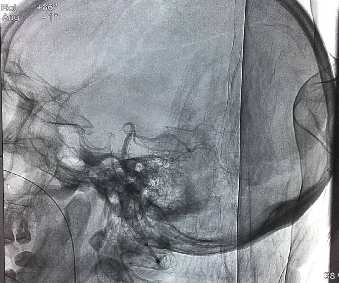 取栓慢性闭塞如何避免血栓逃逸,急性大脑中动脉栓塞取栓时间