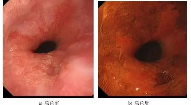 常见的内镜染色方法原理、内镜下表现