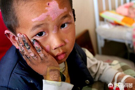 不小心被烟花伤到手了怎么办,不小心被炮竹伤到眼睛怎么办