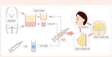 脂肪移植术后需要注意什么,自体脂肪移植填充泪沟多久恢复