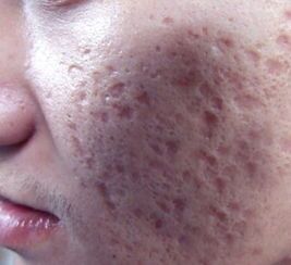 一个大红痘痘周围有许多小痘痘,痘痘中有很多水晶状的痘痘