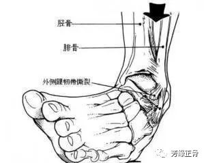 运动员踝关节扭伤后热敷还是冷敷,微垫脚之后脚踝扭伤怎么快速恢复