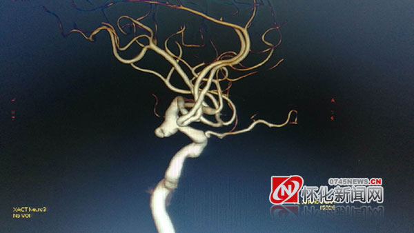 脑袋动脉瘤破裂大面积出血,头痛一下突然很慌担心脑出血