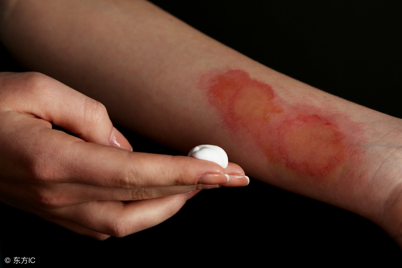 正确处理烫伤或烧伤的方法是,烫伤抹酱油的正确方法