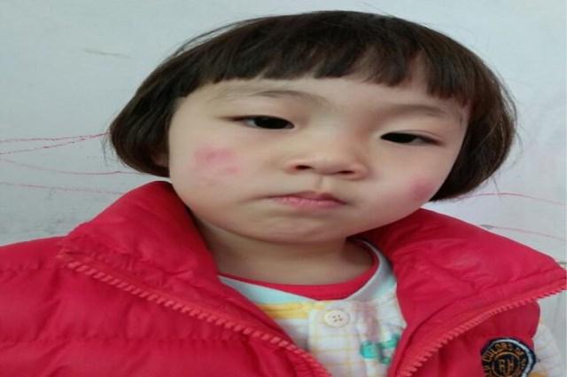 宝宝冬天手长冻疮,宝宝冻疮的原因及治疗方法