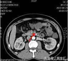间歇性呕吐怎么回事,右上腹痛还伴有反酸