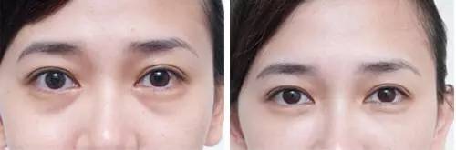 自体脂肪填充川字纹保持多久,自体脂肪填充10天内效果图