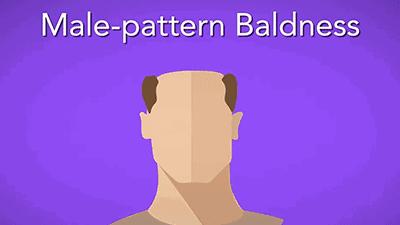 日本研究秃顶,日本教授秃头研究