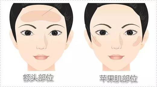 自体脂肪填充川字纹保持多久,自体脂肪填充10天内效果图