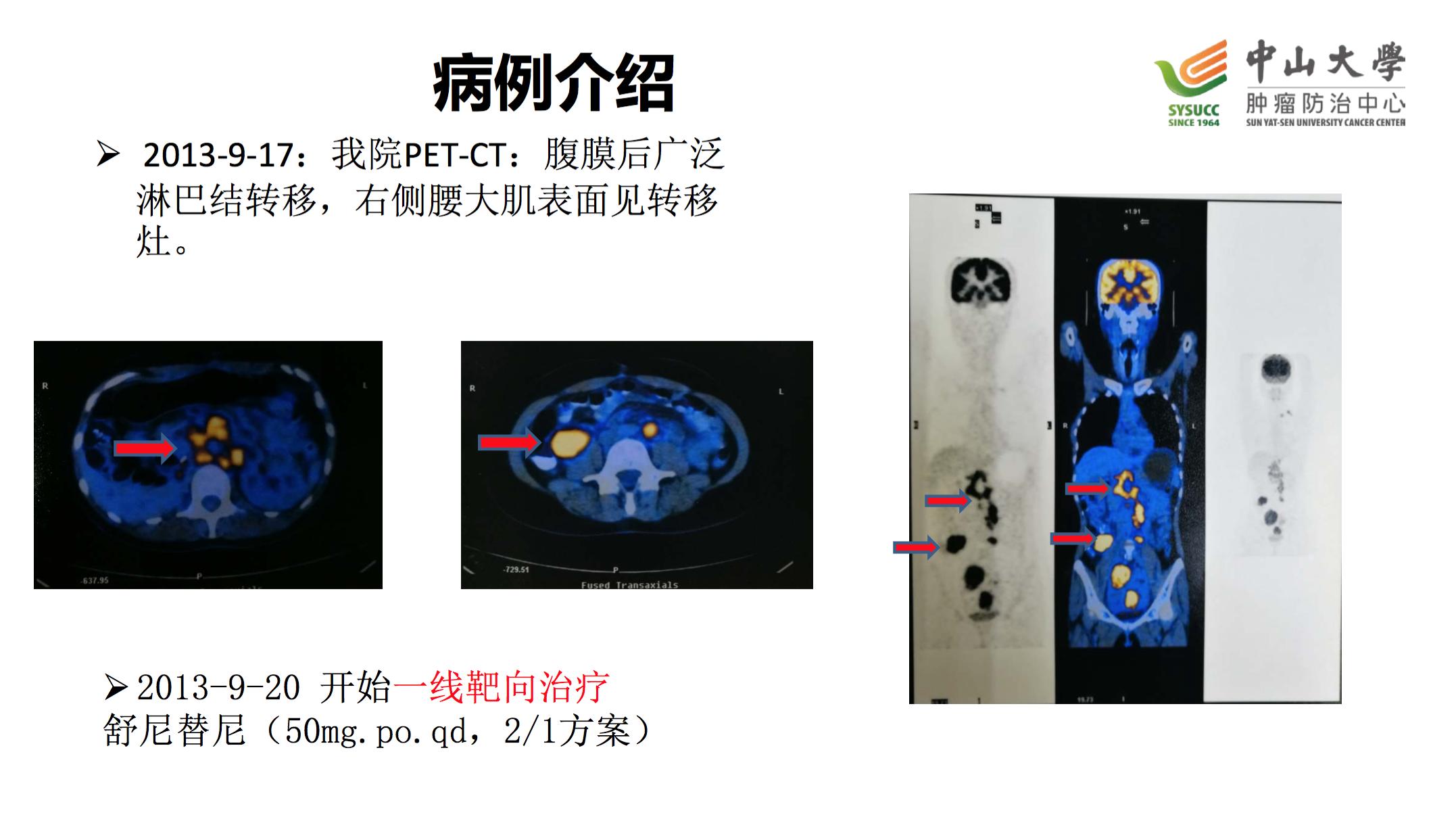 阿昔替尼联合单抗效果好吗,阿昔替尼联合免疫治疗肾癌