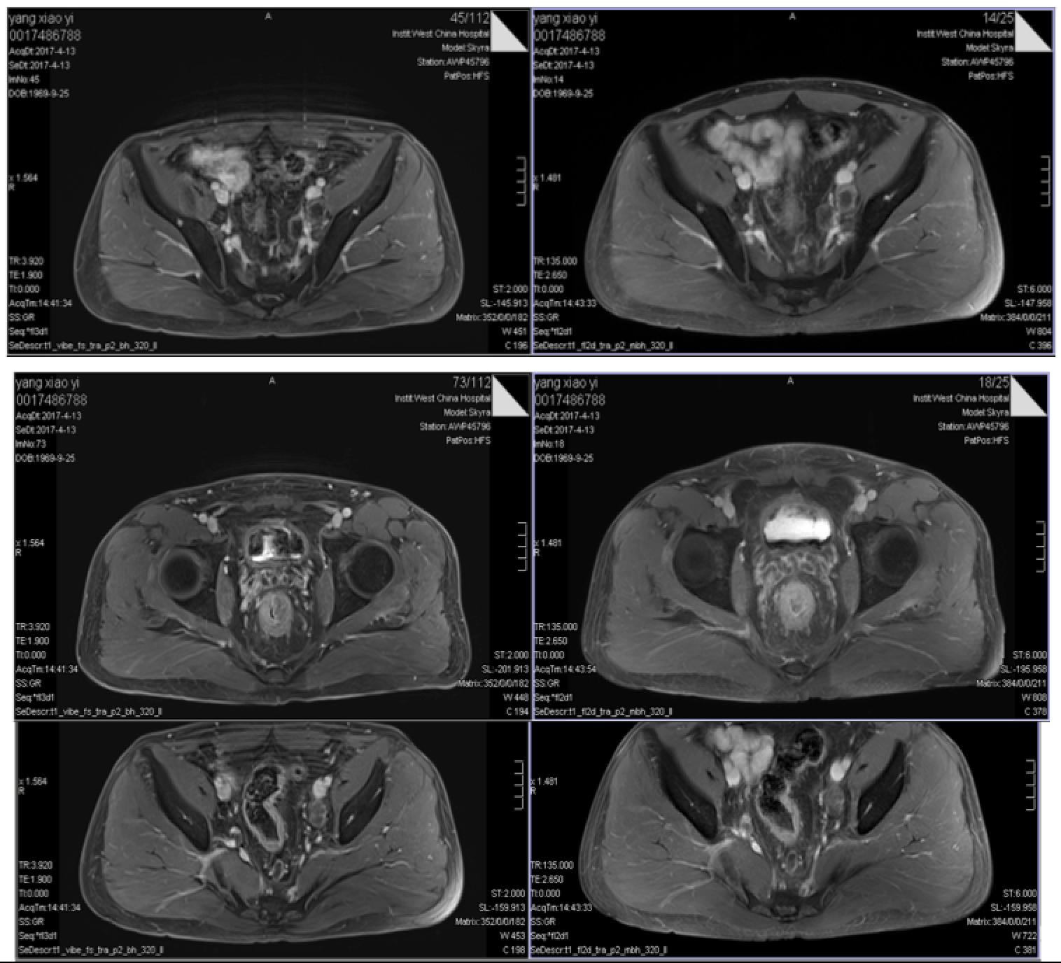 直肠腺癌肺转移最好的治疗方案,得了直肠腺癌不治疗能活几年
