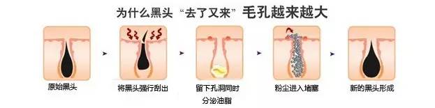 黑头为啥挤了第二天就出来了,黑头挤了两三次会变大嘛